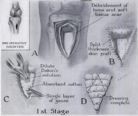 medical illustration showing treatment for chronic bone infection